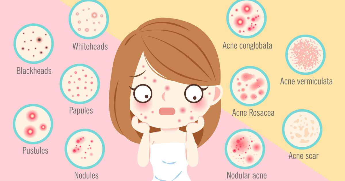 ঘরোয়া টোটকায় মুক্তি নিশ্চিত ব্রণর দাগ থেকে! (how to remove acne scars naturally at home)